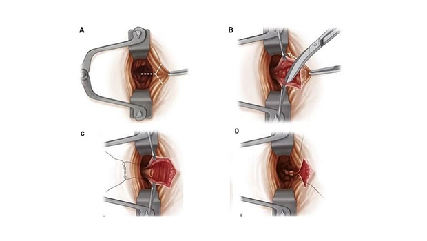 هموروئیدکتومی-Hemorrhoidectomy.jpg